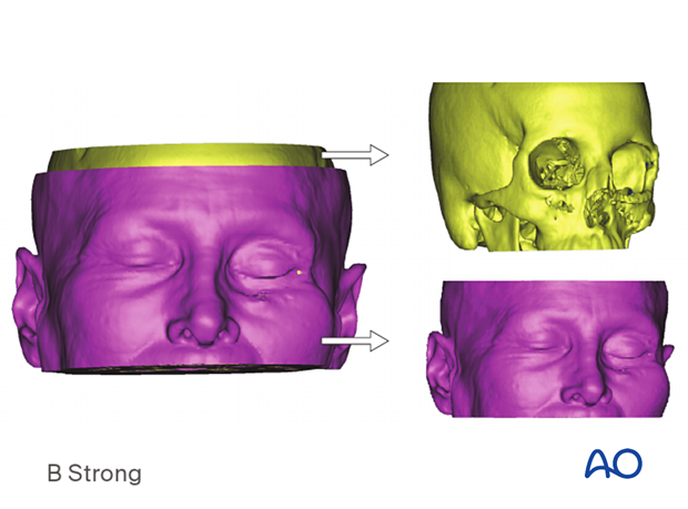Computer assisted surgery – segmentation