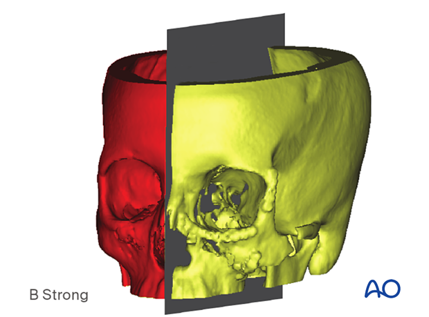 Computer assisted surgery – segmentation