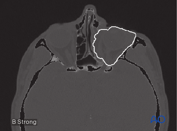 Computer assisted surgery – segmentation