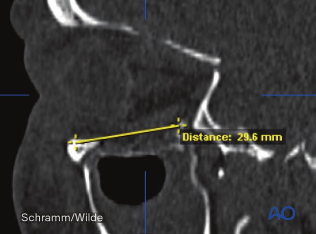 Computer assisted surgery – preoperative analysis