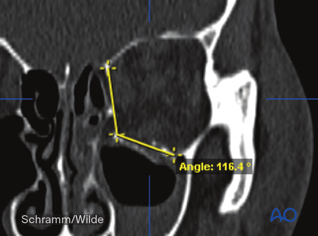 Computer assisted surgery – preoperative analysis