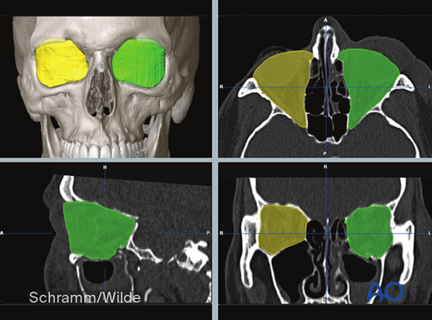 Computer assisted surgery – preoperative analysis