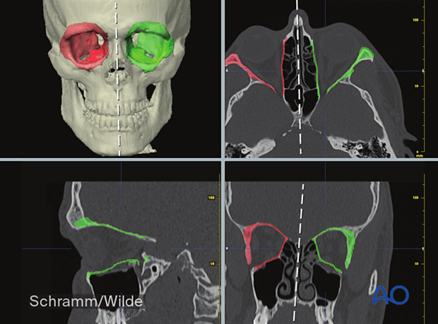 Computer assisted surgery – mirroring