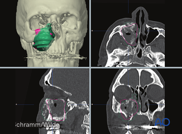 Computer assisted surgery – Presurgical planning/Virtual surgery