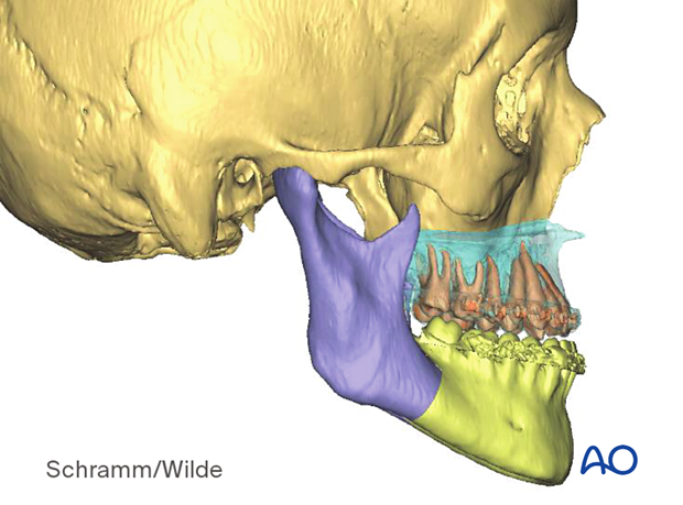 Computer assisted surgery – Presurgical planning/Virtual surgery