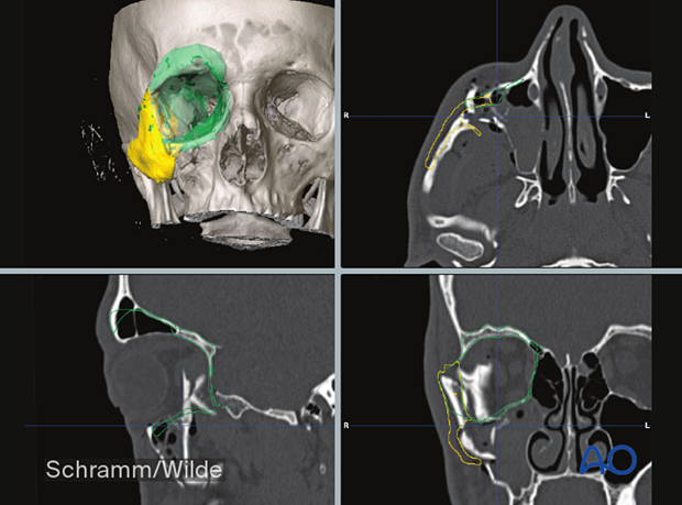 Computer assisted surgery – Presurgical planning/Virtual surgery