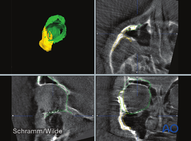 Computer assisted surgery – image fusion