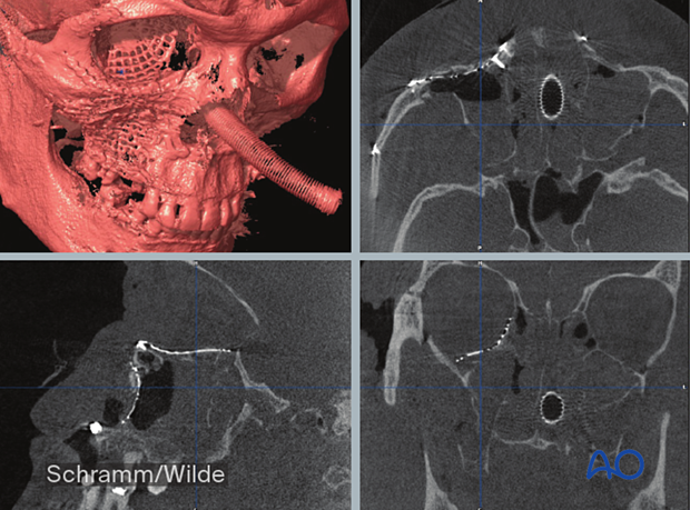 Computer assisted surgery – Intraoperative CT