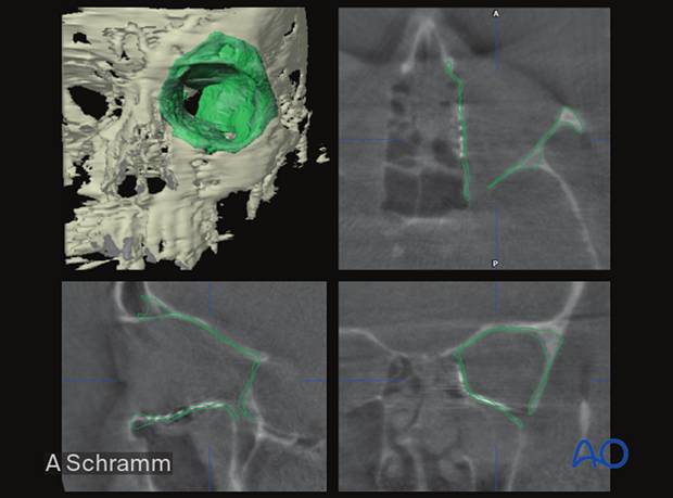 Computer assisted surgery – Intraoperative CT