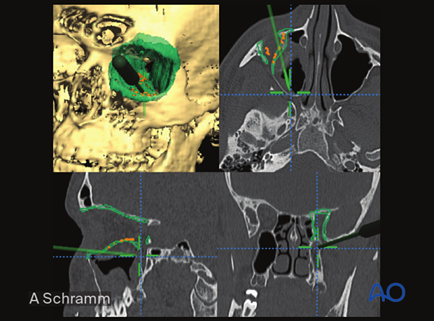 Computer assisted surgery – Intraoperative navigation