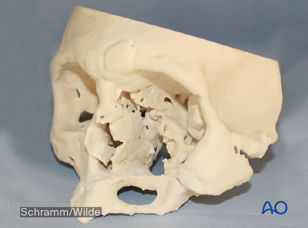 Computer assisted surgery – Anatomic 3D models
