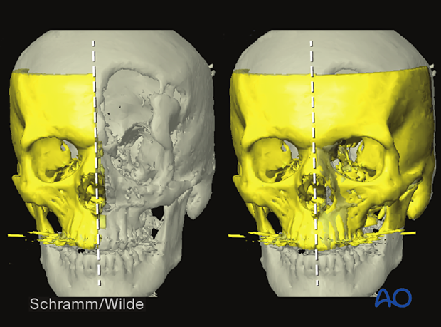 Computer assisted surgery – Anatomic 3D models