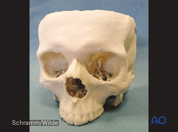 Computer assisted surgery – Anatomic 3D models