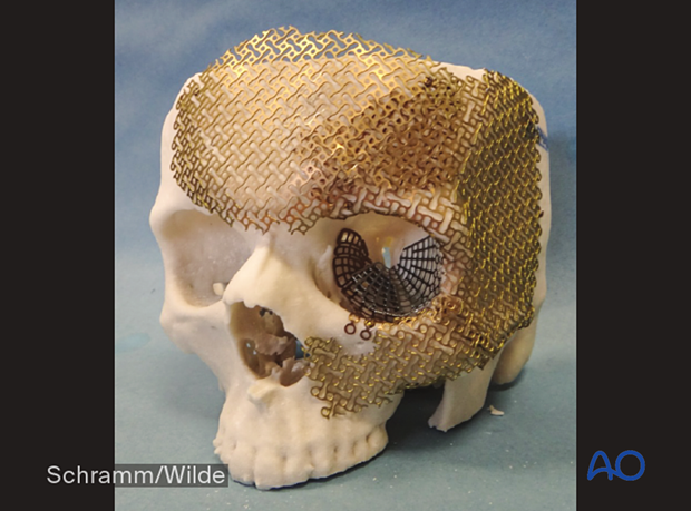 Computer assisted surgery – Anatomic 3D models