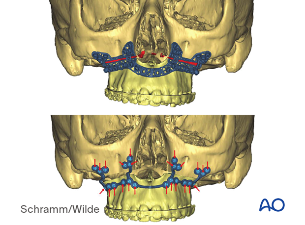 Computer assisted surgery – Patient-specific surgical guides and templates