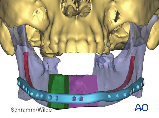 Computer assisted surgery – Patient-specific surgical guides and templates