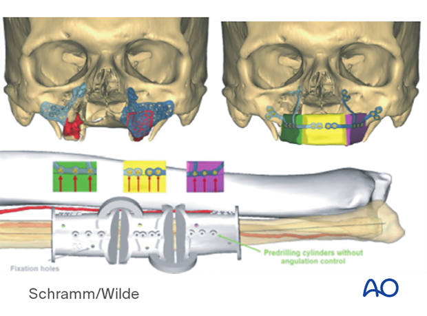 Computer assisted surgery – Patient-specific surgical guides and templates