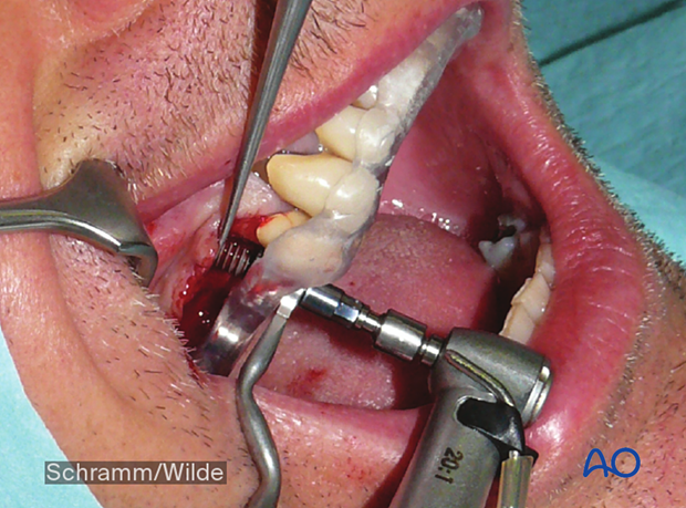Computer assisted surgery – Patient-specific surgical guides and templates