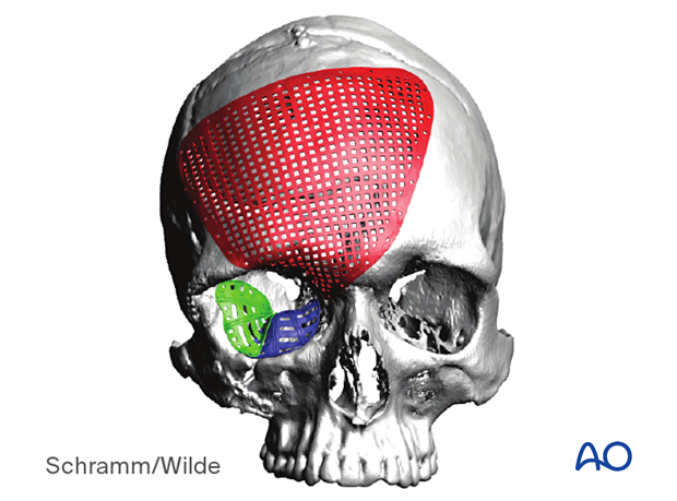 Computer assisted surgery – Patient-specific implants