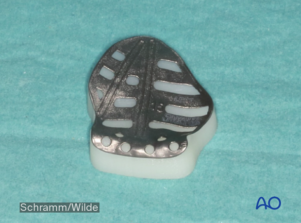 Computer assisted surgery – Patient-specific implants