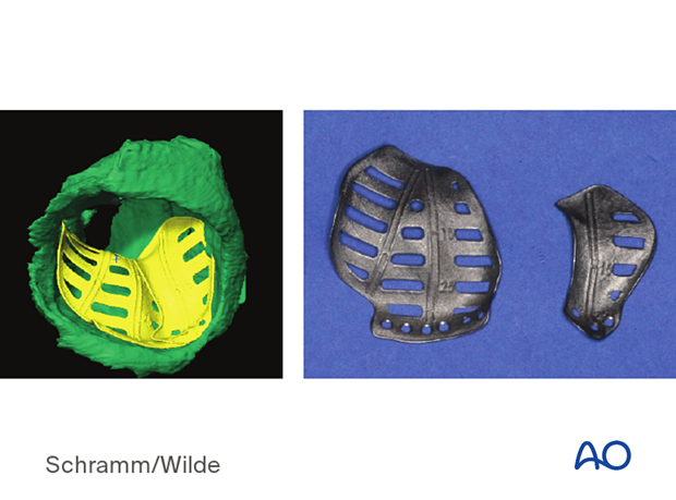 Computer assisted surgery – Patient-specific implants