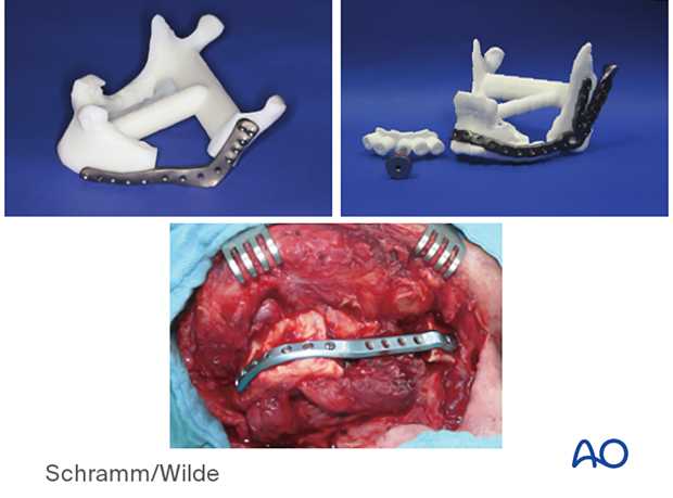 Computer assisted surgery – Patient-specific implants