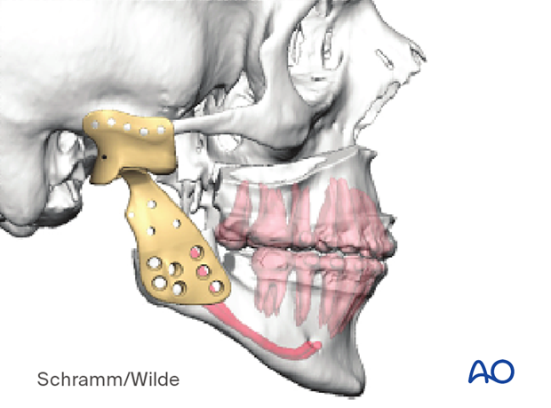 Computer assisted surgery – Patient-specific implants