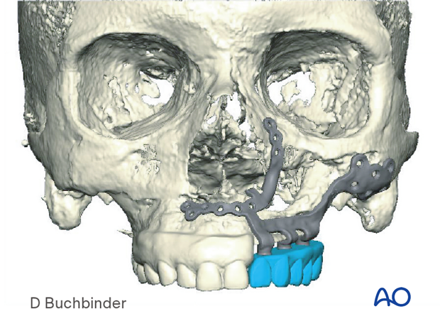 Computer assisted surgery – Patient-specific implants