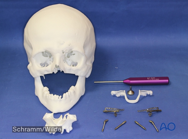 Computer assisted surgery – Patient-specific implants