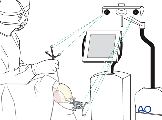 Intraoperative navigation system with direct line of sight between the digitizer camera and the reference arrays during registration and navigation – computer assisted surgery.