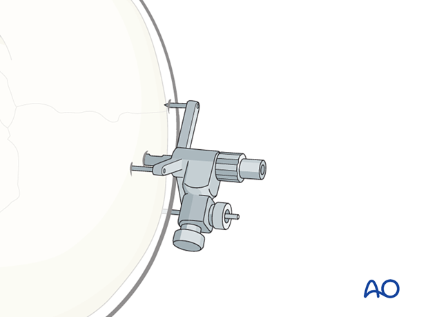 Skull post is affixed to the cranium – CAS preparation for intraoperative navigation.