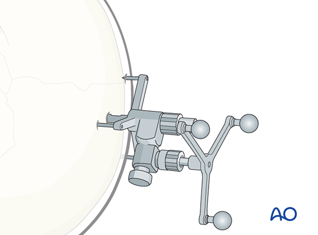 Dynamic reference frame attached to the skull post – CAS preparation for intraoperative navigation.
