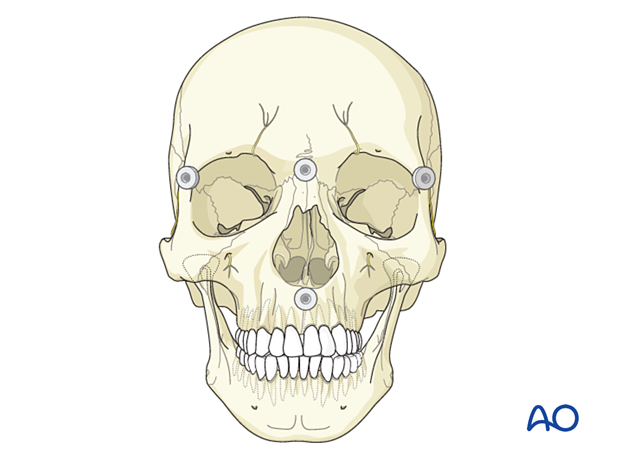 Four anatomical fiducials defined on the virtual patient model in CAS preparation for intraoperative navigation.