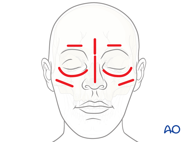 Large number of anatomical fiducials for patient skin surface registration in CAS preparation for intraoperative navigation.