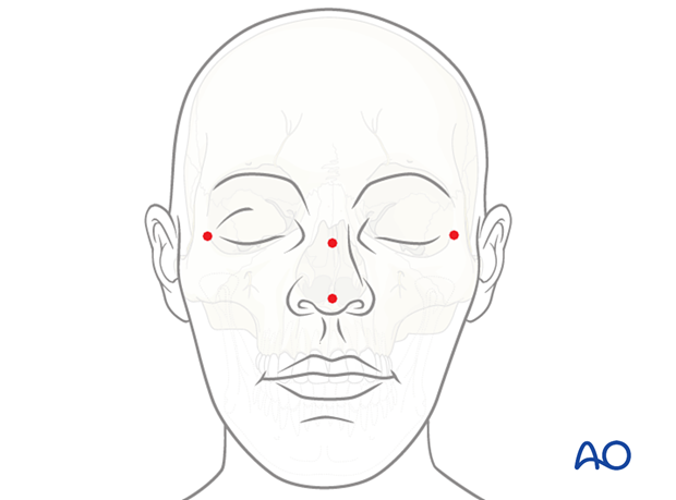 Anatomic landmarks for patient skin surface registration in CAS preparation for intraoperative navigation.