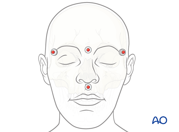 Placement of fiducial markers on the skin for CAS preparation for intraoperative navigation.