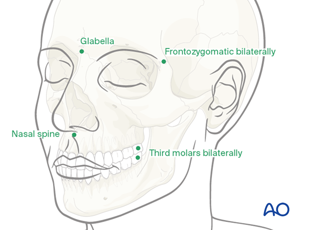 Bony landmarks defined on the virtual patient during the presurgical planning landmarks during CAS preparation for intraoperative navigation.