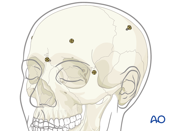 Bony landmarks defined using bone screws in non-movable skull segments as fiducials for registration – CAS preparation for intraoperative navigation.