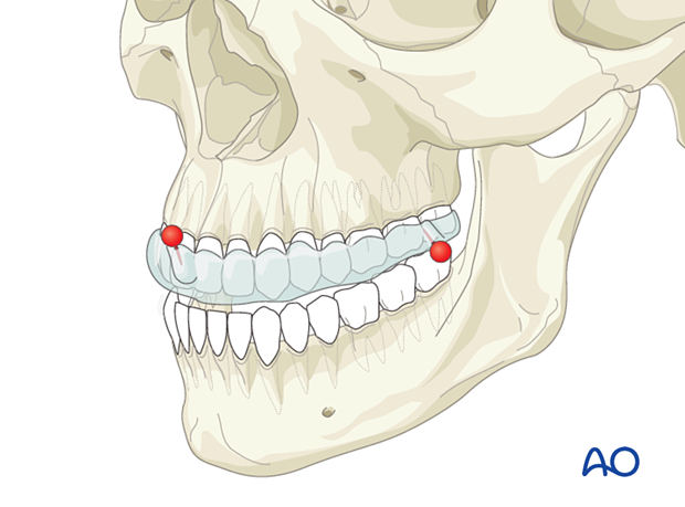 splint containing fiducial markers fitted onto the maxillary dentition – CAS preparation for intraoperative navigation.