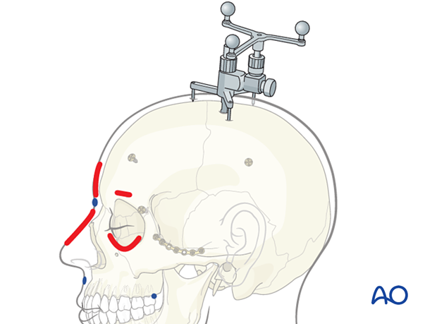 Dynamic reference frame, anatomic landmarks, drill holes, ink marks, screws for registration – CAS preparation for intraoperative navigation.