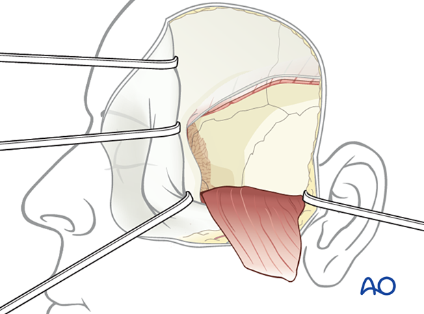 Adjunctive access procedures (orbitotomies) - exposure of lateral orbital wall via temporal/infratemporal fossa approach