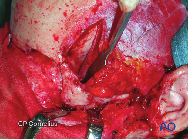 Adjunctive access procedures (orbitotomies) - exposure of lateral orbital wall via temporal/infratemporal fossa approach