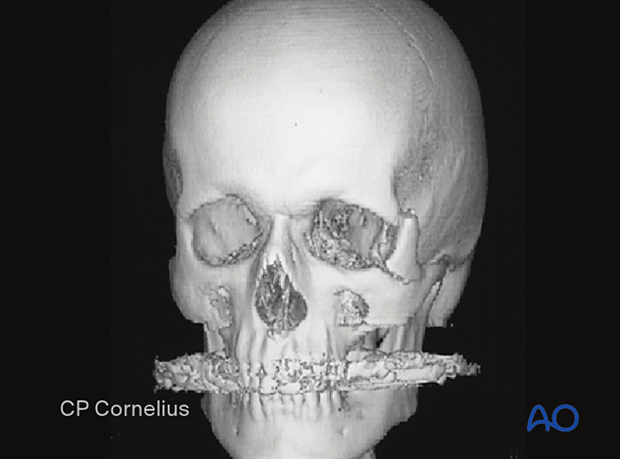 Adjunctive access procedures (orbitotomies) - lateral marginotomy