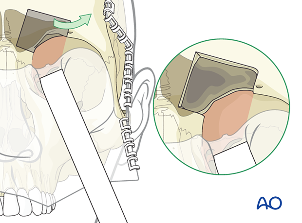 Adjunctive access procedures (orbitotomies) - superomedial marginotomy
