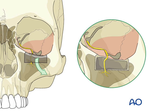 Adjunctive access procedures (orbitotomies) - inferior marginotomy
