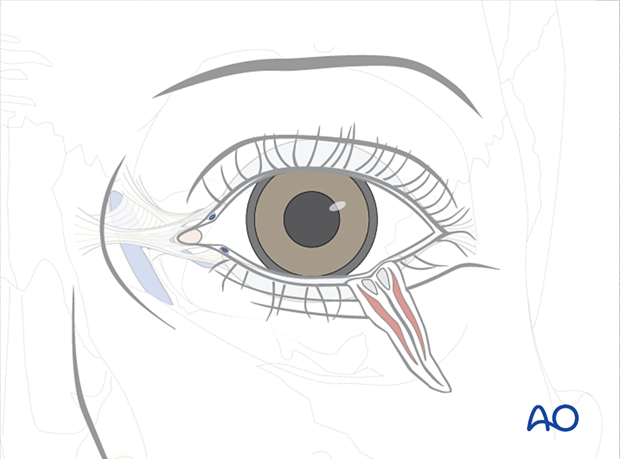 Partial thickness eyelid laceration