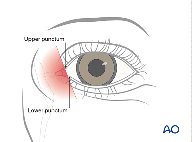 Full thickness eyelid laceration