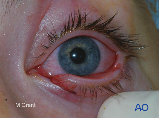 Full thickness eyelid laceration
