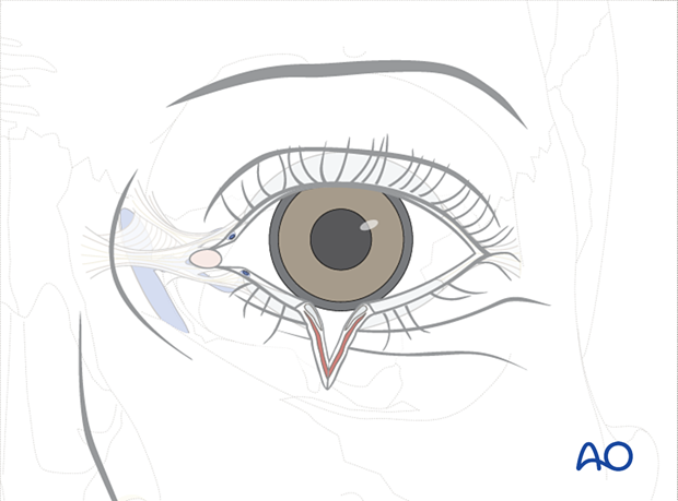 Full thickness eyelid laceration (without canalicular involvement)