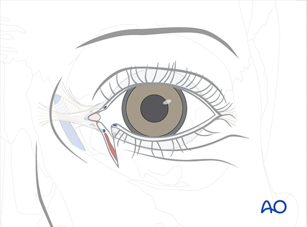 Full thickness eyelid laceration (with monocanalicular involvement)